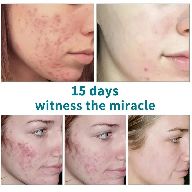 Pore Shrinking Cream Acne Pit Repair Product for Men/Women