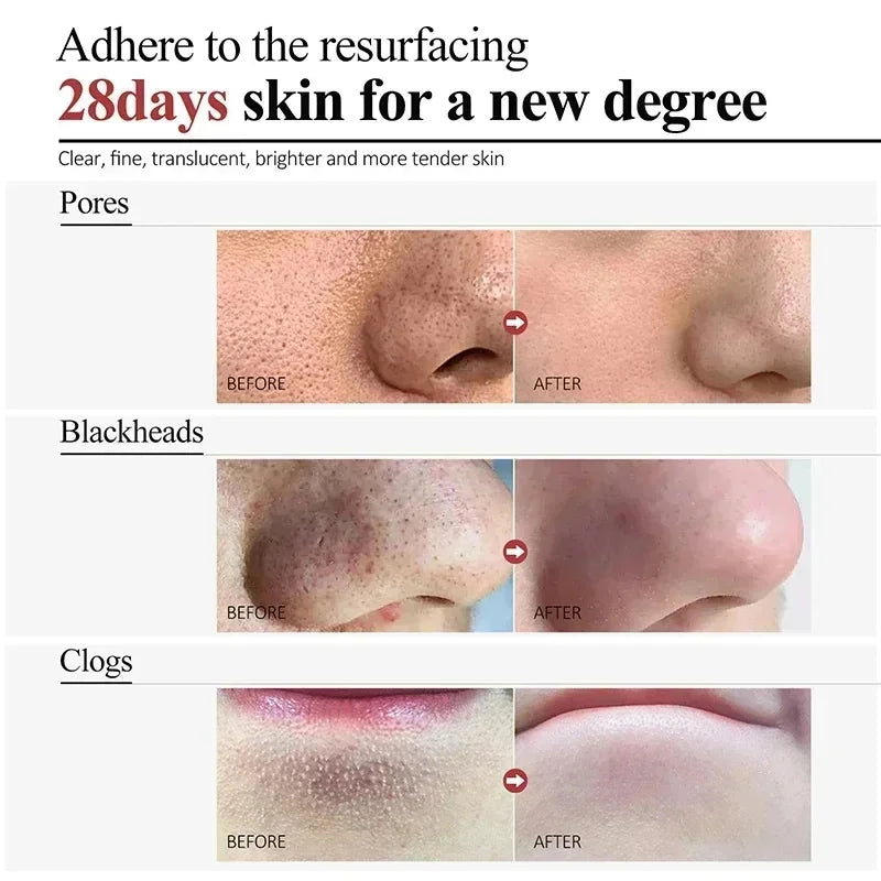 Pore Shrinking Cream Acne Pit Repair Product for Men/Women