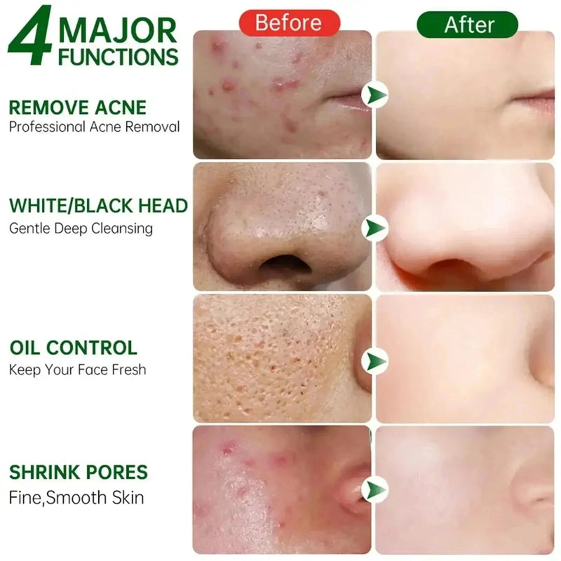 Pore Shrinking Cream Acne Pit Repair Product for Men/Women