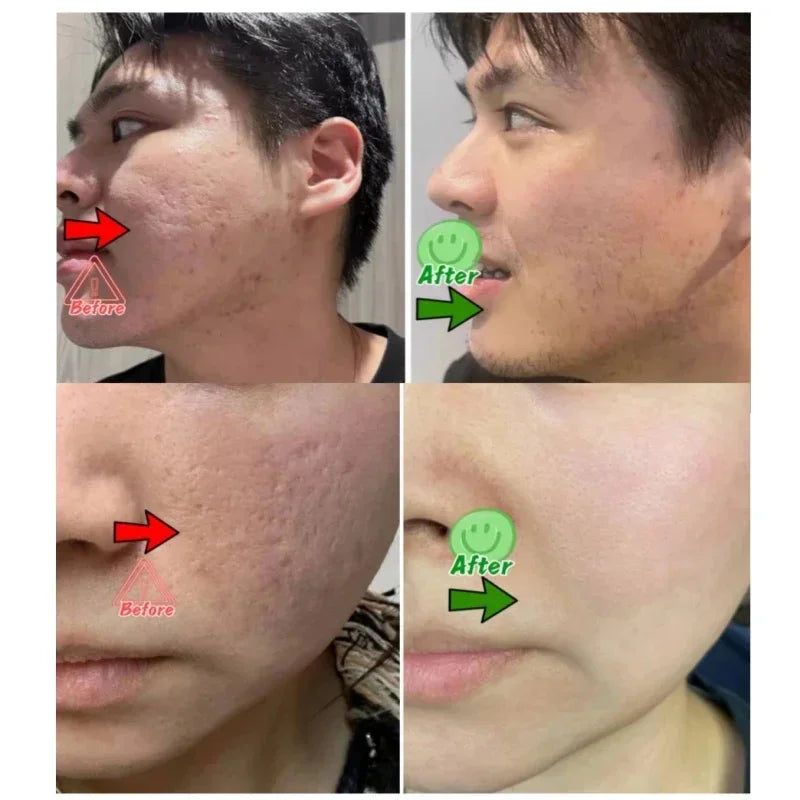 Pore Shrinking Cream Acne Pit Repair Product for Men/Women